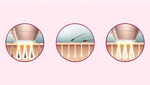 Mehr informationen finden sie außerdem unter. Lumea Advanced Ipl Haarentfernungsgerat Bri921 00 Philips