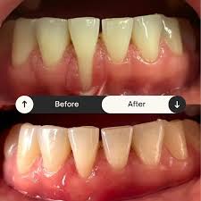 Image result for Periodontitis