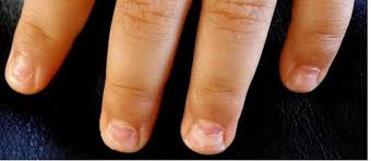 Peeling Nails Nails Falling Off Onychomadesis After Hand Foot And Mouth In Kids Peeling Nails Nail Falling Off Hand Foot And Mouth