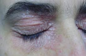 Image result for dermatitis contacta