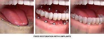 Full Mouth Dental Implants All On 6 Dental Implants Dental Implants Mini Dental Implants Dental Implant Procedure