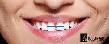 But metal braces aren't your only treatment option. Diy Braces Why You Should Not Participate In The Trend Burlingame Smile Studio