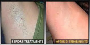 Hair removal day spas skin care. What Is The Best Hair Removal Method Laseraway
