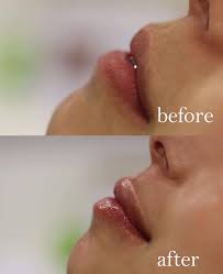 Her eyes were blue flowers; I Had Lip Fillers And This Is What Happened It S Not What You Think Healthista