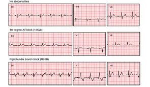 Ai Tool Allows Automated Ecg Interpretation For Cardiac Diagnostics Daic