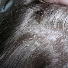 16 Common Causes And Symptoms Of Dandruff Dry Scalp Remedy Dry Scalp Treatment Oils For Dandruff