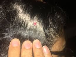 Skin Concerns Red Dot On Scalp Skin Red Dots Behind Ear Tattoo