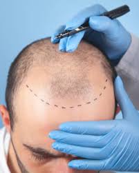 What is hair transplant? Who is suitable candidate and how to find best hair  transplant doctor: Here's a complete guide | Health
