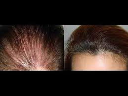 زراعة الشعر عند المرأة زراعة الشعر للنساء
