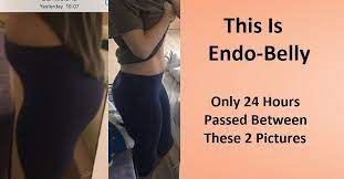 Many women with endometriosis experience endo belly, or severe bloating related to their endometriosis. Endo Belly Is Often The Least Talked About The Symptom That Endometriosis Has On The Body I Can D Endometriosis Symptoms Endometriosis Treatment Endometriosis
