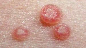 Bleeding can begin when these minor moles get scratched or shaved. What Is A Cherry Angioma Causes Treatment And Removal