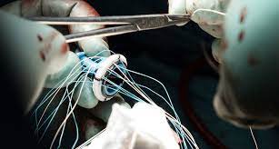 Biologische Herzklappen Hohere Sterblichkeit Bei Jungeren Patienten