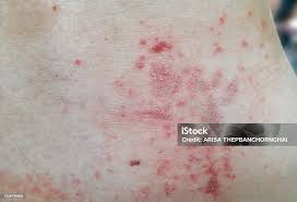Image result for sweat rash on back
