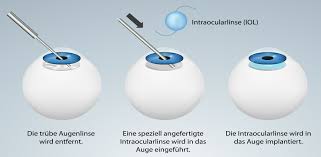Grauer Star Katarakt Kantonsspital Winterthur Ksw