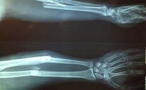 Stat change broken bones iv scriptgui roblox unpatched. The Most Common Broken Bones In The Body The Top 10 Enable Law