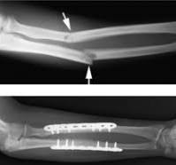 Forearm (Radius and Ulna) Fractures | Reno Orthopedic Center