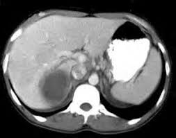 Image result for Liver Abscess