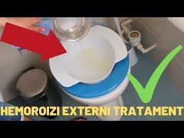 Tratamentul hemoroizilor trebuie să înceapă cu tratarea constipației, aceasta fiind principala lor cauză. Pin On Sanatate