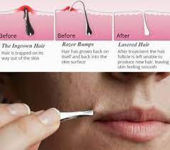 Use a damp cloth to gently wipe off the cream and remove unwanted hair. How Can You Treat Ingrown Hair Get More Insights On How To Remove Ingrown Hair On Legs Face Neck Armpi Ingrown Hair Remedies Ingrown Hair Treat Ingrown Hair