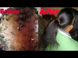 Hair loss is a common concern for many men and women. 2 Ingredients For Fastest Hair Growth At Home Naturally Julia Beauty Youtube Fast Hair Growth Treatment Hair Growth Faster Ways To Grow Hair