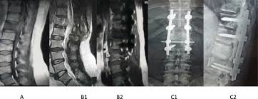 Prostate cancer is a common type of cancer in men, according to the mayo clinic. Surgical Management And Prognostic Factors Of Spinal Metastatic Tumors Egyptian Journal Of Neurosurgery Full Text