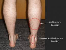 The lower leg itself, referring to the area between the ankle and knee, is composed mainly of muscles lying around two thin but very strong long bones a swollen calf may arise as a sign of inflammation following injury to one or more structures of the leg. Calf Muscle Tear Footeducation