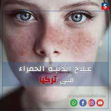 Vi sono altre patologie associate; Ù…Ø±Ø¶ Ø§Ù„Ø°Ø¦Ø¨Ø© Ø§Ù„Ø­Ù…Ø±Ø§Ø¡ ÙˆÙØ±Øµ Ø§Ù„Ø¹Ù„Ø§Ø¬ Ø§Ù„Ø¹Ù„Ø§Ø¬ ÙÙŠ ØªØ±ÙƒÙŠØ§