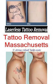 The Best Tattoo Removal How Long Does It Take To Get Laser Tattoo Removal Can You Remove A Tattoo With Lemon Tattoo Removal Cost Laser Tattoo Tattoo Removal