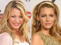 Blake Lively Nose Job How She Changed After Plastic Surgery In 2020 With Images Celebrity Plastic Surgery Blake Lively Nose Nose Job