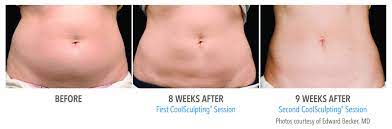How long does coolsculpting last. Dallas Coolsculpting Fat Freezing Procedure In Plano