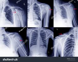 Image result for Shoulder XRay