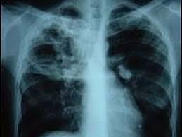 Tuberculoza, o boală infecto-contagioasă | Jurnal Spiritual