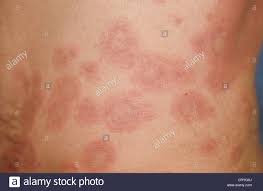 Tusenvis av nye høykvalitetsbilder legges til daglig. Lupus Skin Disease Stockfotos Und Bilder Kaufen Alamy
