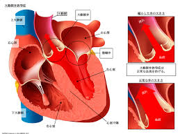 大動脈弁狭窄症について 弁の硬化は加齢とともに進行し、弁が開きにくくなります。 正常大動脈弁 大動脈弁狭窄症（中等度） 大動脈弁狭窄症（高度） リウマチ性 小児期にかかるリウマチ熱(連鎖球菌)によるもの。 å¤§å‹•è„ˆå¼ç‹­çª„ç—‡ç—…æ°—è¾žå…¸