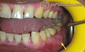 Image result for Periodontal Abscess