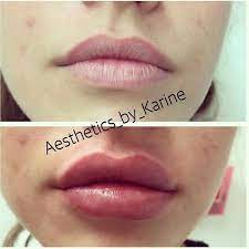 1 syringe of juvederm ultra. Before After Used 1 Syringe Of Juvederm Ultra Plus Xc Beforeafter Juvederm Syringe Ultra Xc Before After Used Restylane Lips Restylane Lip Fillers