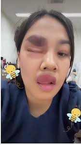 อาการแพ้พิษผึ้ง