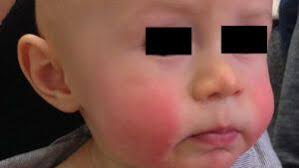 Image result for red rash face