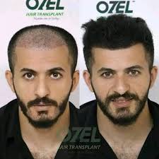 معجزة الطبيعة من شركه ناو فودز ساحر الانبات الاصلي يعمل علي .تحفيز نمو  بصيلات شعر جديدة. .زيادة كثافة الشعر الخفيف. .معالجة الصلع الوراثي والمبكر.  .معالجة تقصف الشعر. 👈 المنتج فعال لعلاج الصلع