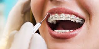 Check spelling or type a new query. Orthodontic Treatment Offered For Everyone Dentist Milton On