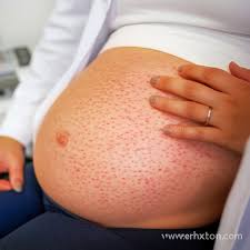 Image result for pruritic urticarial papules and plaques of pregnancy