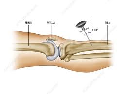 Image result for Intraosseous Access