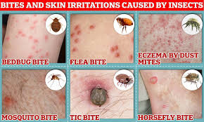 Image result for bedbugs bites
