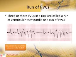 Ppt Ventricular Dysrhythmias Powerpoint Presentation Free Download Id 5204970 Flexible air ducts for ventilation and air conditioning. ventricular dysrhythmias powerpoint