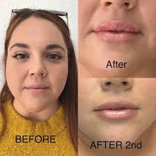 TOP 10 BEST Pdo Thread Lift in Austin, TX