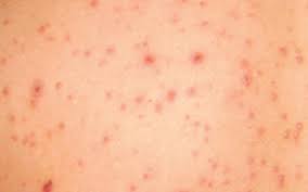 Care sunt simptomele zonei zoster? Poze Blog Poze Cu Pojar La Copii