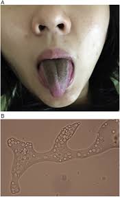 Image result for black tongue symptoms