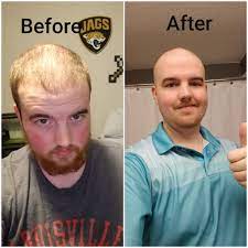 How would i look bald reddit. Updated Look Thanks Guys Bald