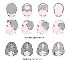 Tout votre cuir chevelu est concerné. Alopecie Troubles Dermatologiques Edition Professionnelle Du Manuel Msd