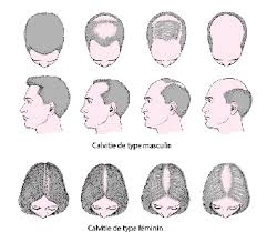 Si cette perte de cheveux dure moins de 6 mois on parle d 'une perte de cheveux aiguë. Alopecie Troubles Dermatologiques Edition Professionnelle Du Manuel Msd